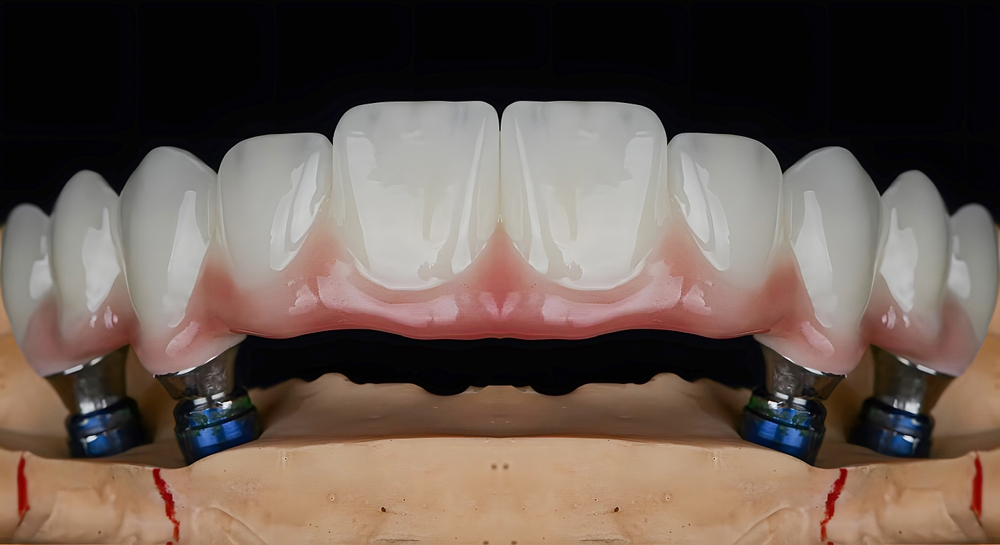 Dental model showing replacement teeth supported by dental implants