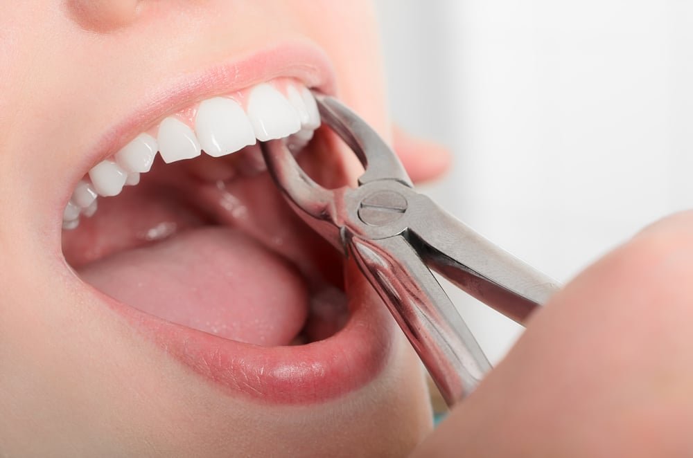 Dental forceps removing a tooth